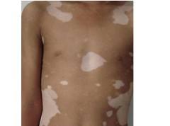 在生活中应该怎样及时有效的预防白癜风